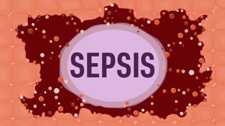 sepsis
