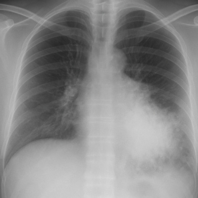 aspiration pneumonia