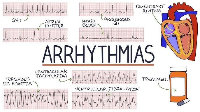 arrhythmias