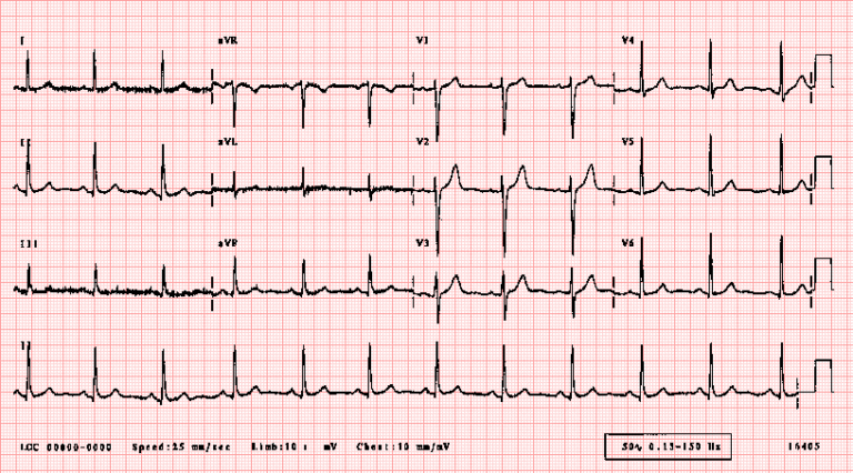 ecg12