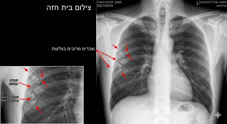 צילום בית חזה שברים בצלעות