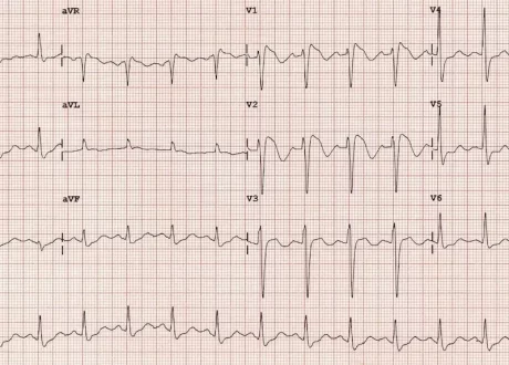 ECG-Brugada-Tyope-1-RBBB-mimic-2