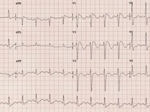 ECG-Brugada-Tyope-1-RBBB-mimic-2