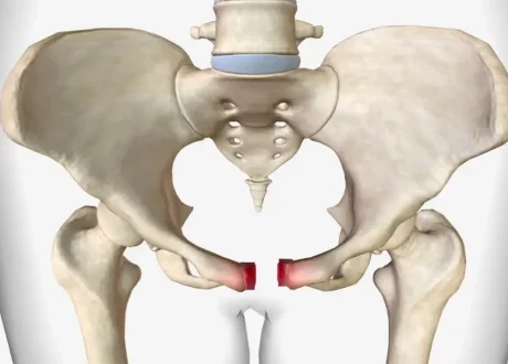 Pelvic-Fracture