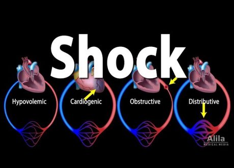 SHOCK