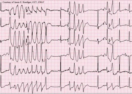 Torsades_de_Pointes_TdP