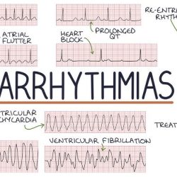 arrhythmias