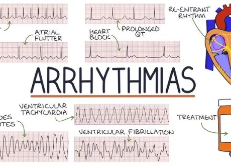 arrhythmias