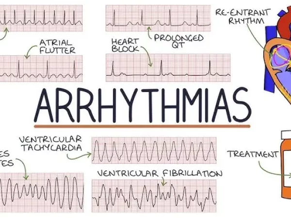 arrhythmias