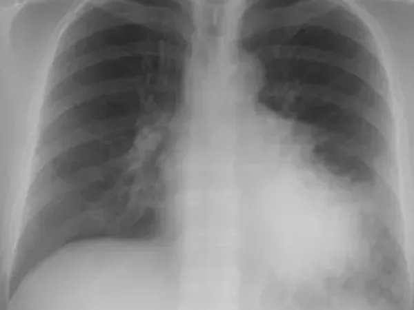 aspiration pneumonia