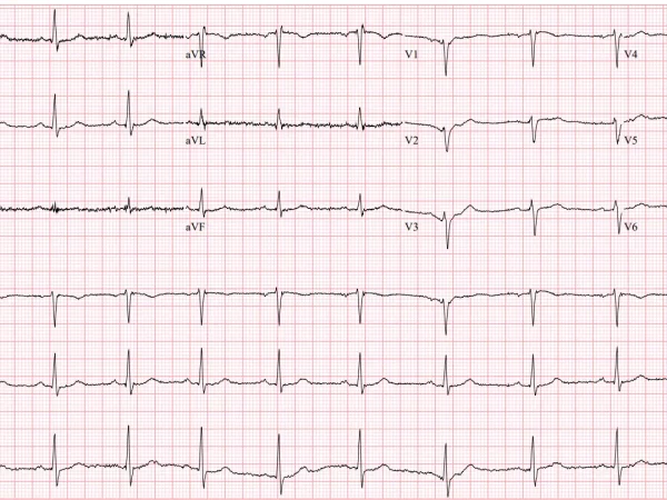 ecg