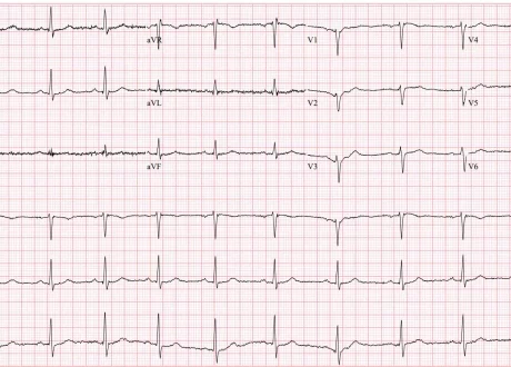 ecg