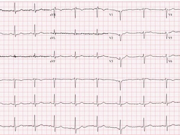 ecg