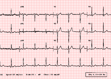 ecg12