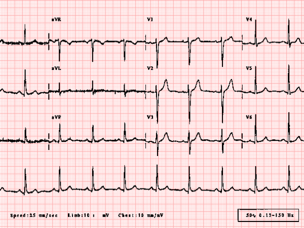 ecg12