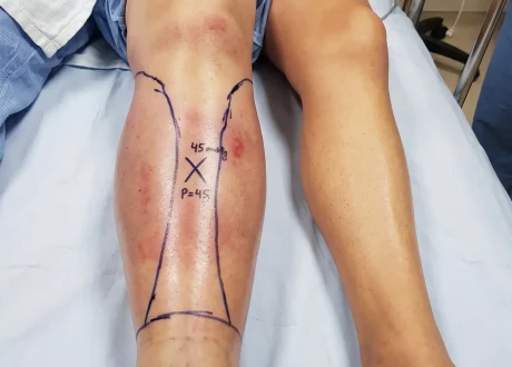 extremity compartment syndrome