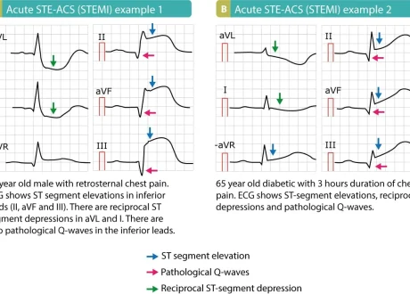 stemi1
