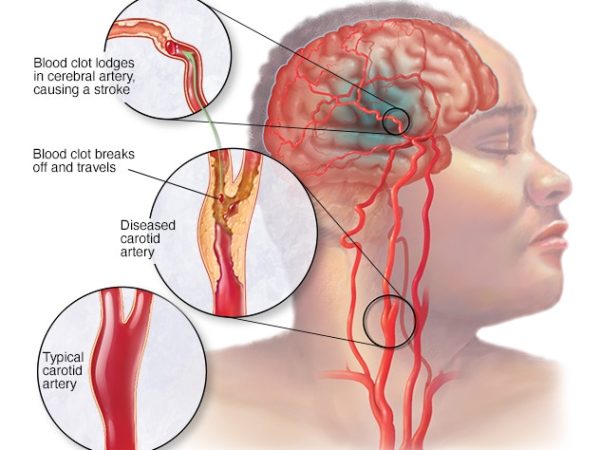 stroke
