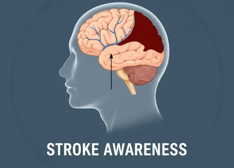 stroke