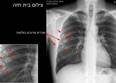 צילום בית חזה שברים בצלעות